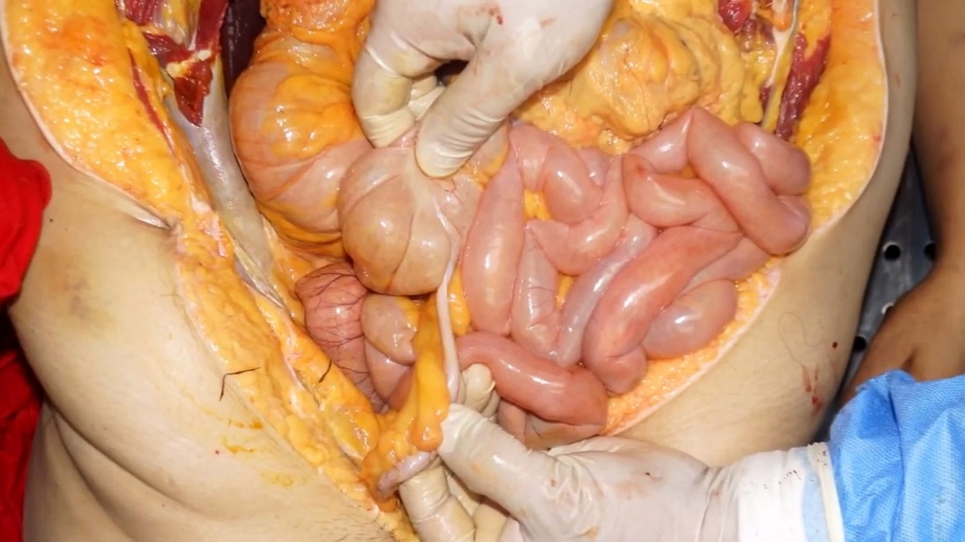 Autopsy of drowned woman