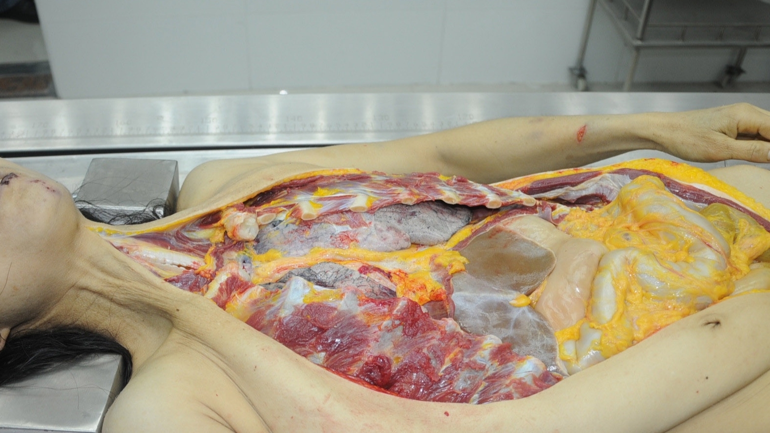 Detailed dissection of stabbed Chinese woman