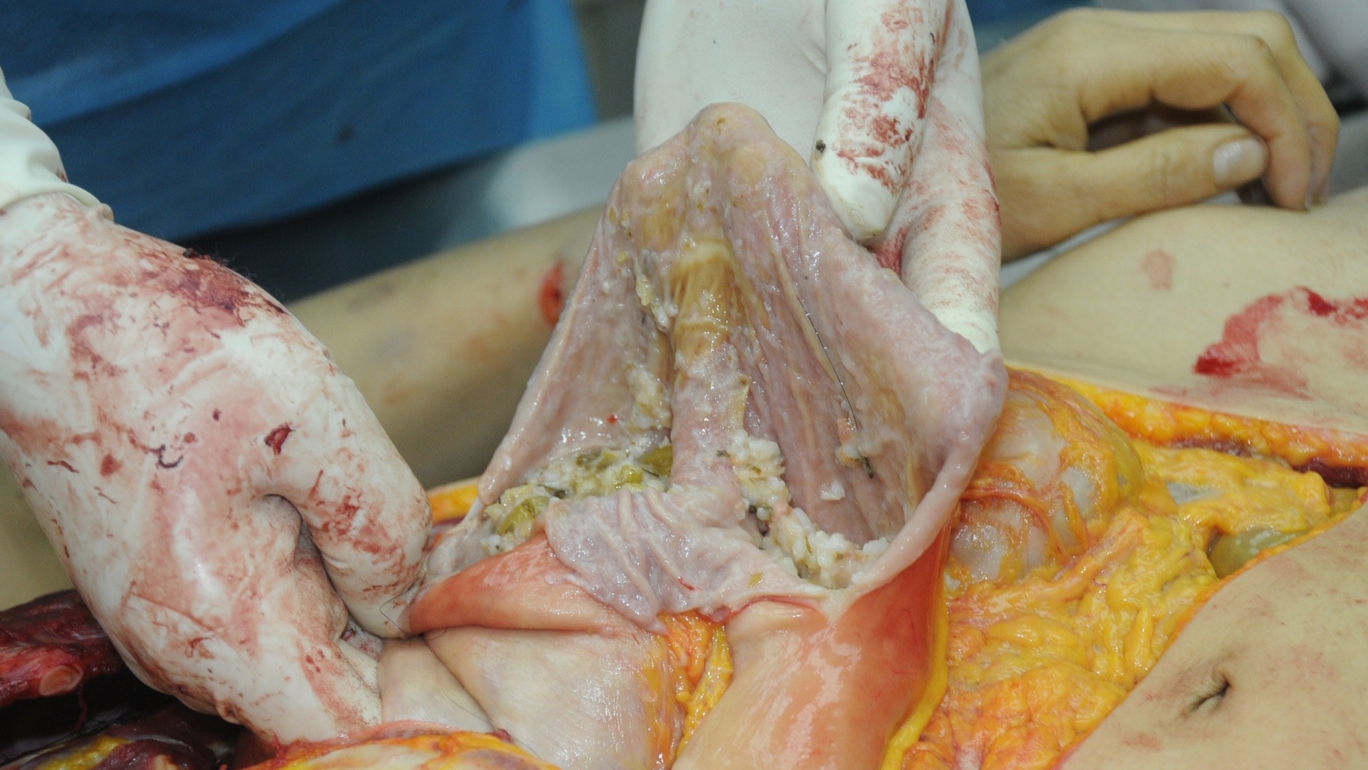 Detailed dissection of stabbed Chinese woman