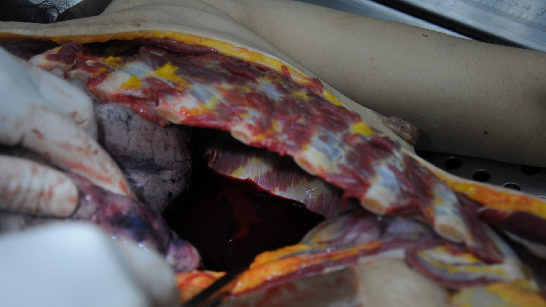 Detailed dissection of stabbed Chinese woman