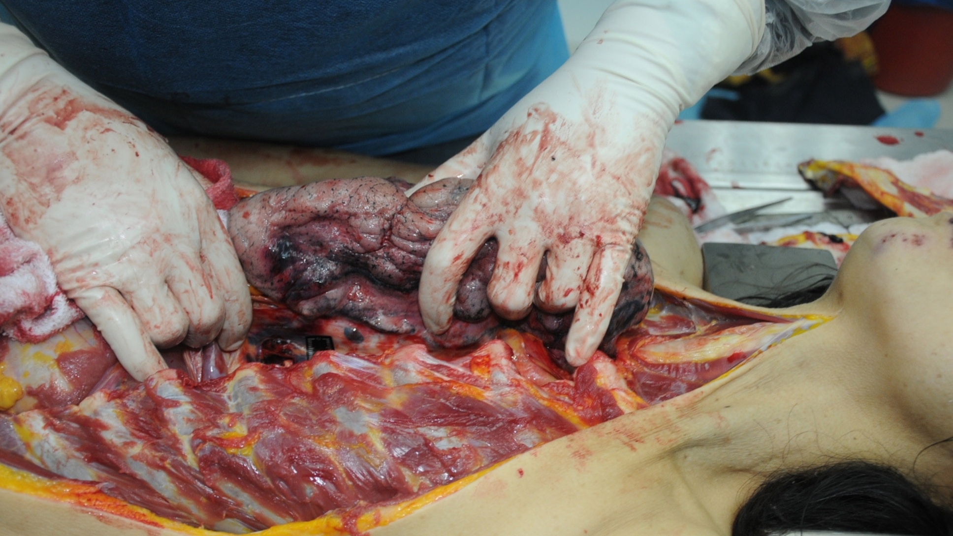 Detailed dissection of stabbed Chinese woman
