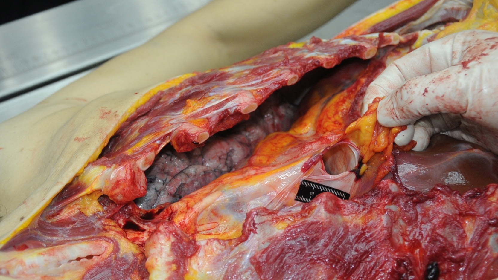 Detailed dissection of stabbed Chinese woman