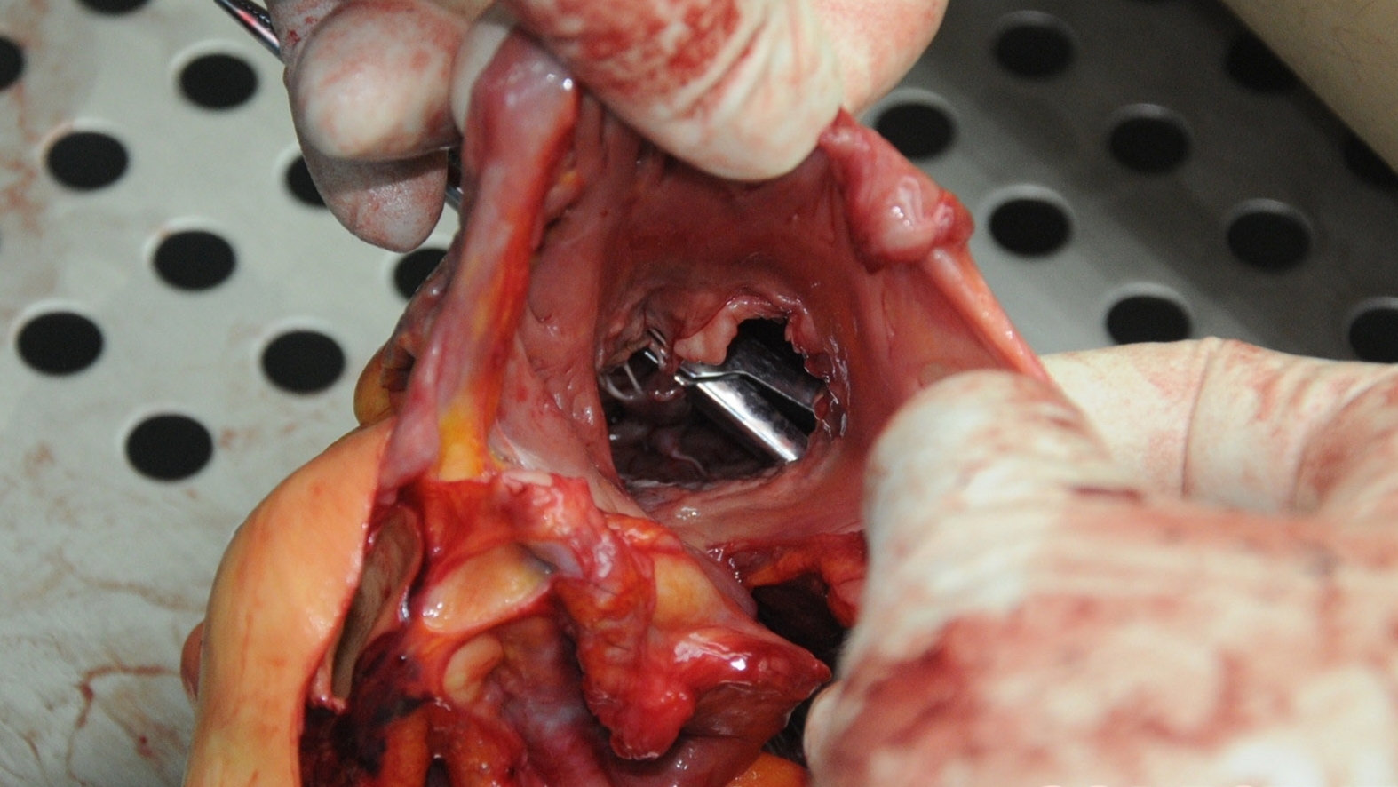 Detailed dissection of stabbed Chinese woman