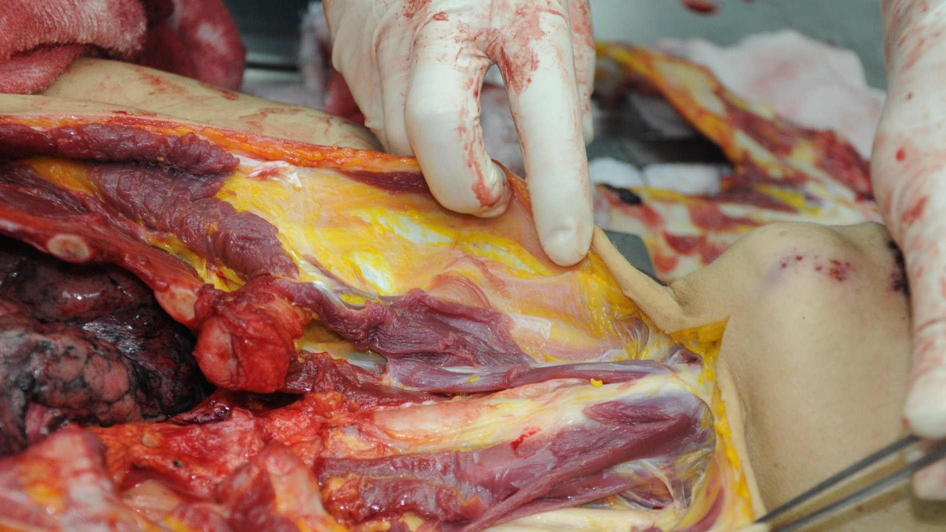 Detailed dissection of stabbed Chinese woman