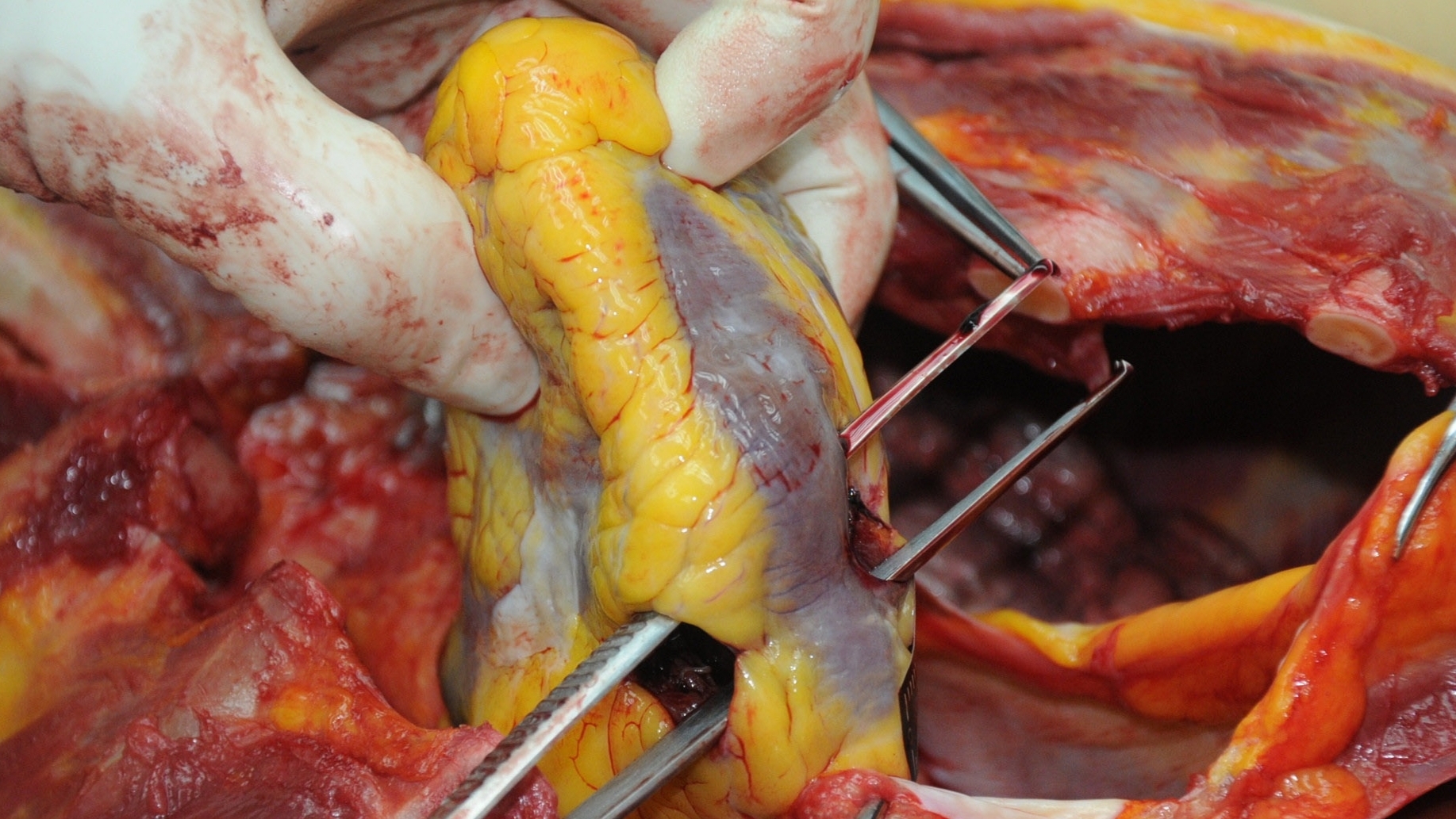 Detailed dissection of stabbed Chinese woman