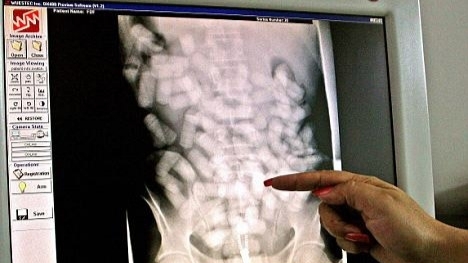 Autopsy of a drug mule