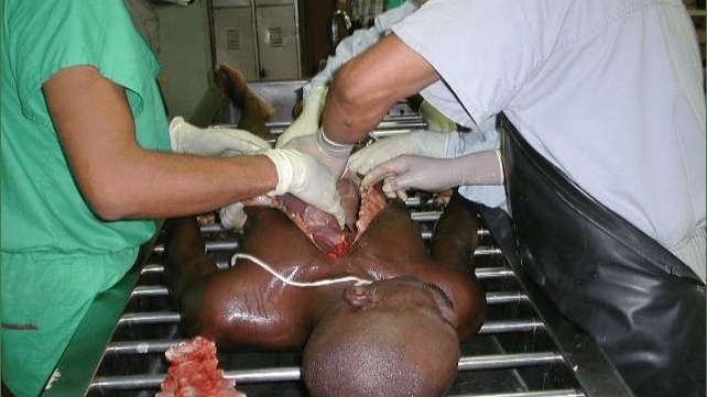 Autopsy of a drug mule