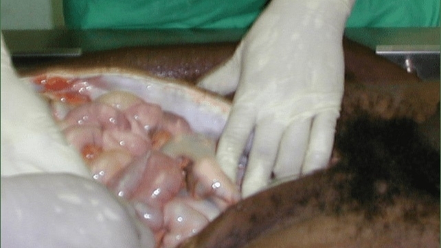 Autopsy of a drug mule