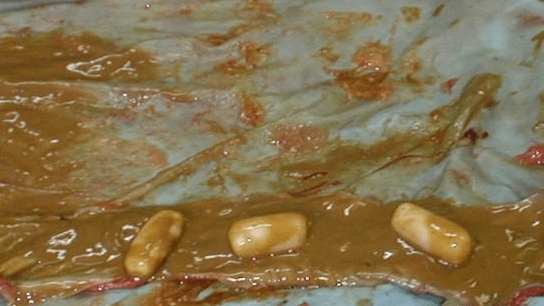 Autopsy of a drug mule