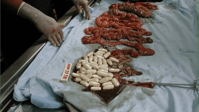 Autopsy of a drug mule
