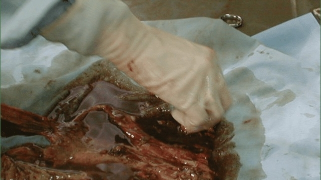 Autopsy of a drug mule