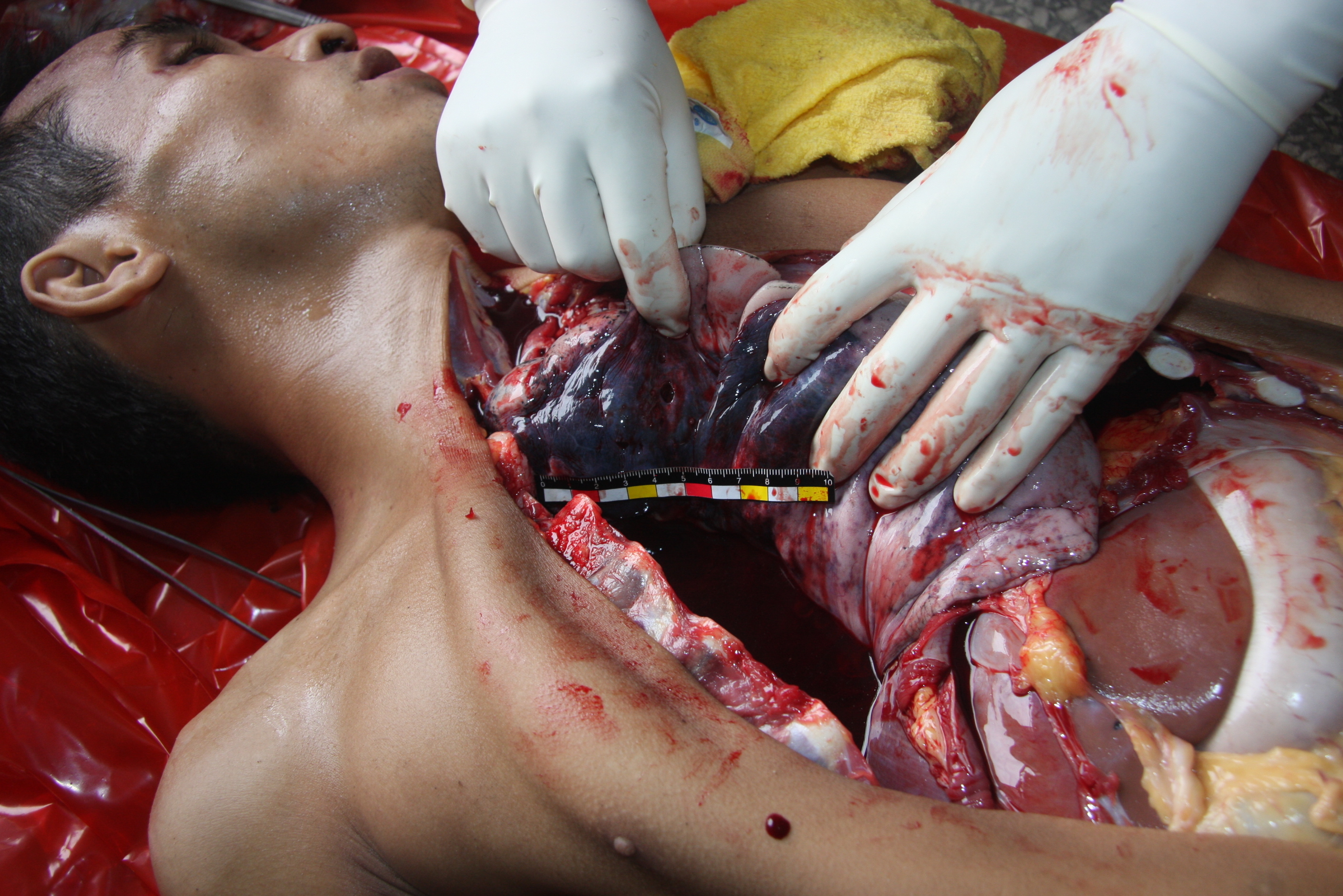 the autopsy of Chinese man