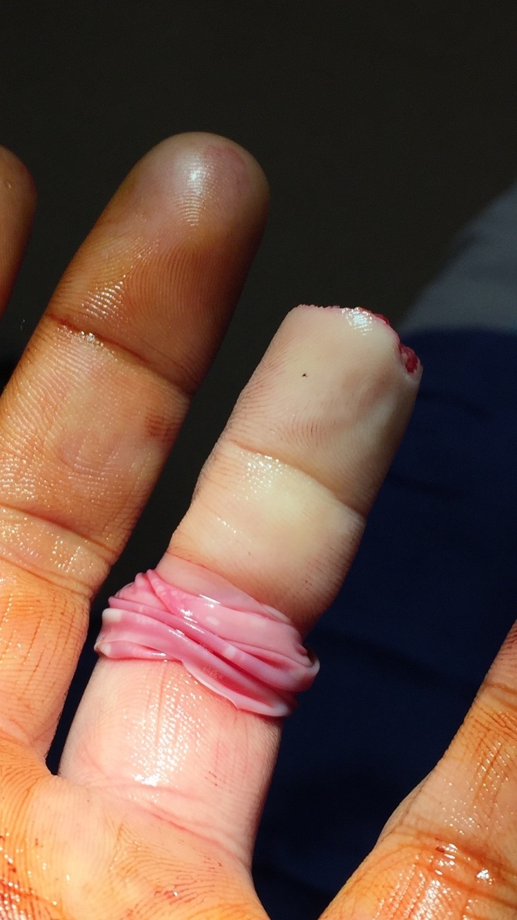 Fingertip amputation