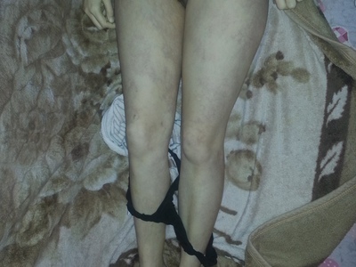 Young woman dies from suspected drug overdose