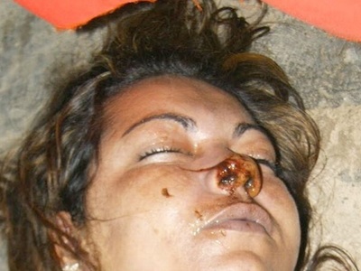 Drug user woman died from overdose 