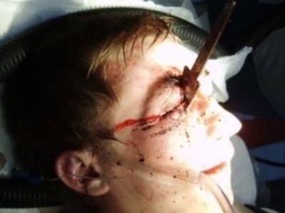 Russian woman stabbed in the eye by her drunk husband 