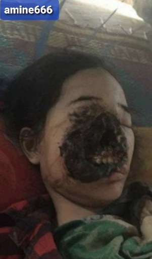 Young Indian Woman Suffering From The 'black fungus'