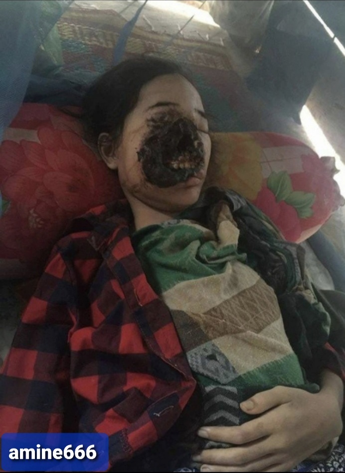 Young Indian Woman Suffering From The 'black fungus'