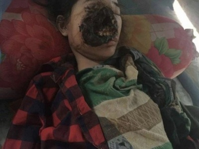 Young Indian Woman  Suffering From The 'black fungus' 