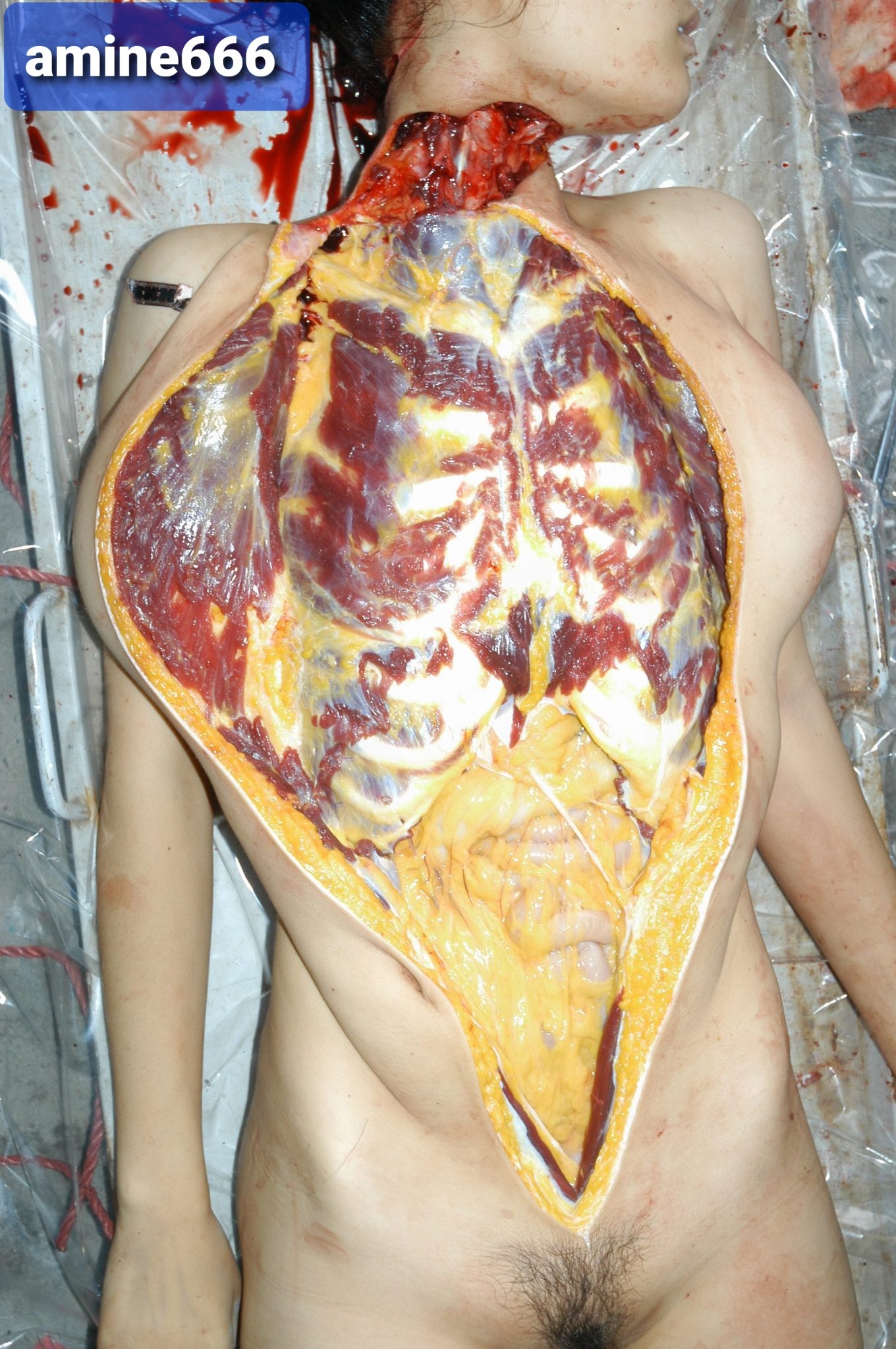 Autopsy of Chinese girl killed by cutting her throat