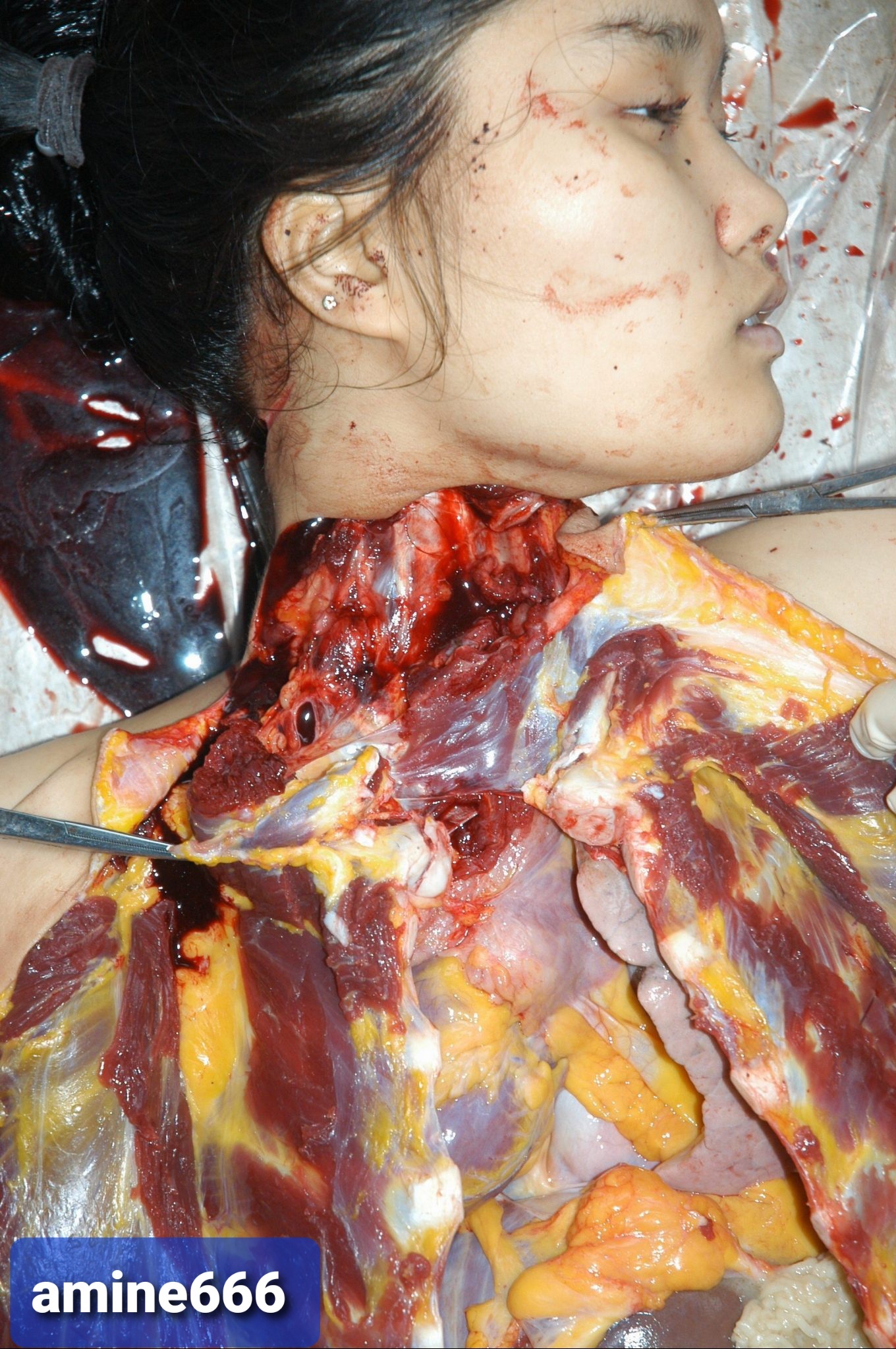 Autopsy of Chinese girl killed by cutting her throat