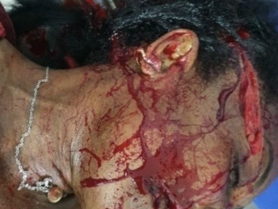 Brazilian woman victime of machete attacks 