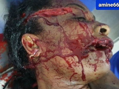 Brazilian woman victime of machete attacks 