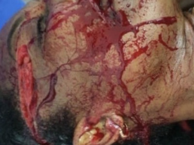 Brazilian woman victime of machete attacks 