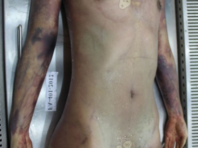 Examination nude dead corps of Chinese young women 