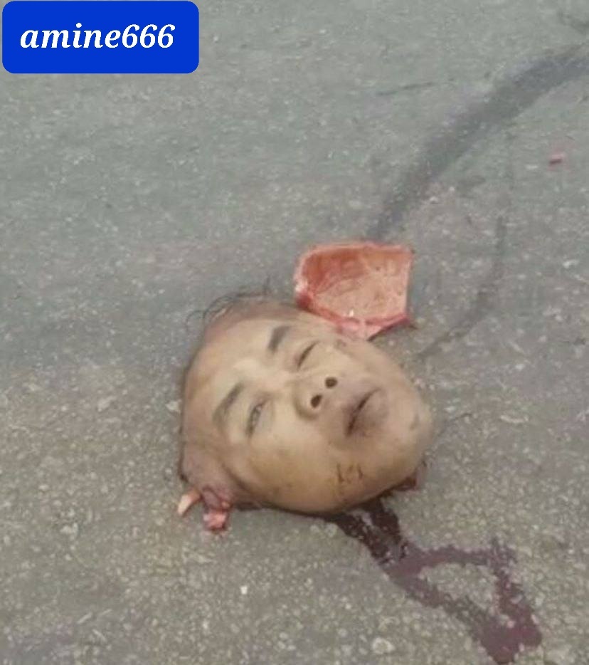 Man died in horrific accident his face removed from his place