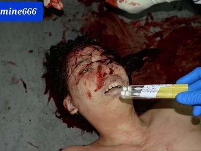 Chinese young woman had her skull crashed in parking 