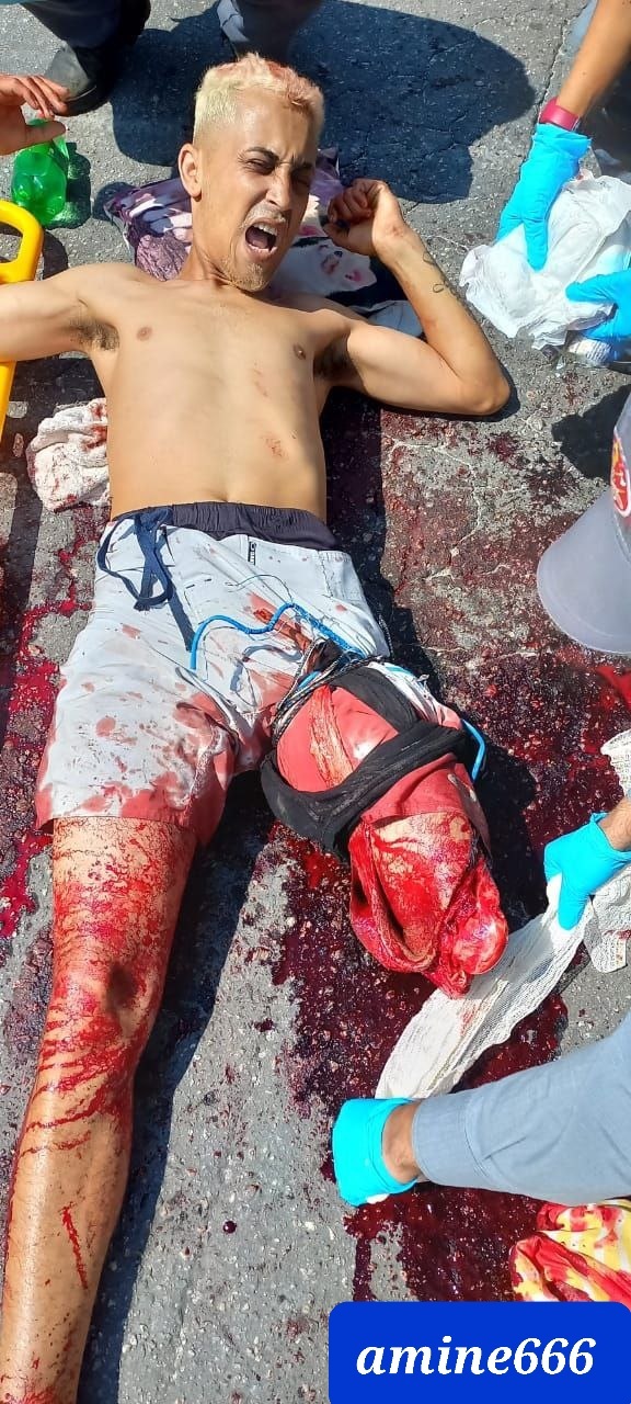 Motorcyclist lost his leg and still alive