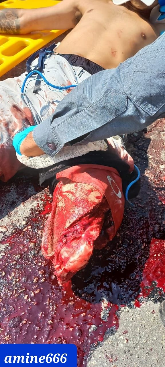 Motorcyclist lost his leg and still alive