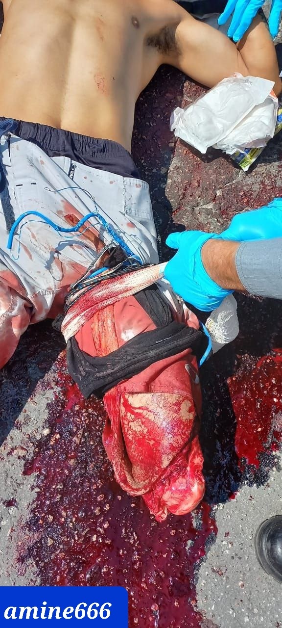 Motorcyclist lost his leg and still alive