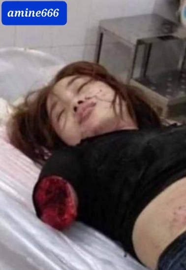 Cute Girl Loses Her Arm in Deadly Accident.