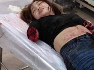 Cute Girl Loses Her Arm in Deadly Accident.