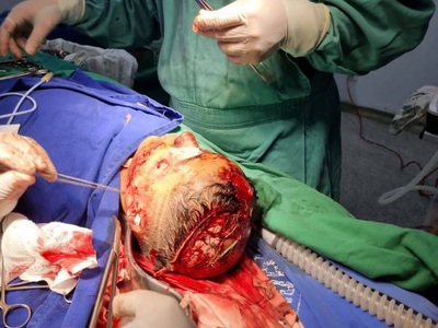 Little boy mauled and scalped by pitbull 