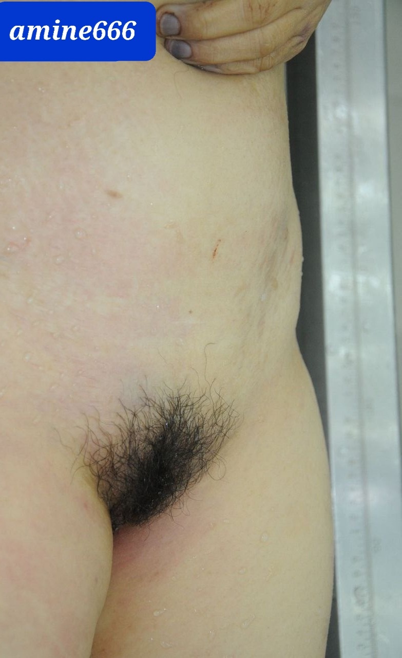 Examination a nude dead corps of ugly Chinese women