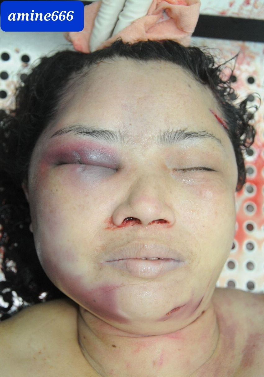 Examination a nude dead corps of ugly Chinese women