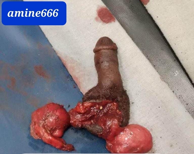 Woman Drugged Then Castrated her Cheating Husband.