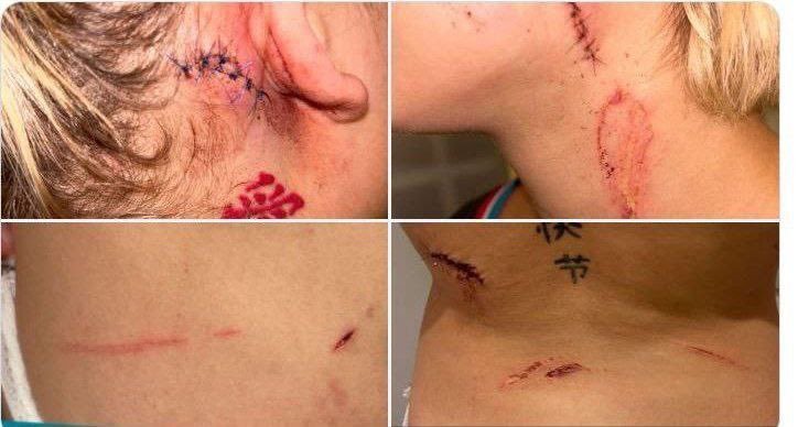 French Teen Is Brutally Assaulted, Slashed by Migrants for Clothing