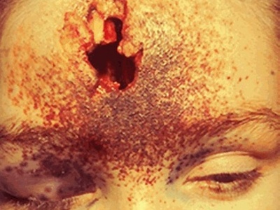 Close range gunshot to forehead