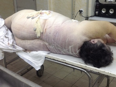 Fat woman on slab