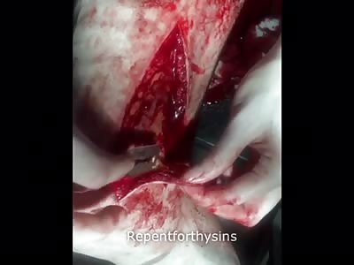 P1. Removing flesh of my leg