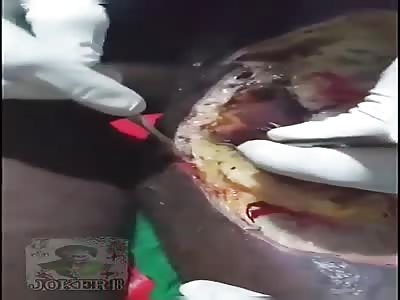 Man with rotten leg in hospital 