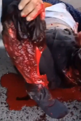 Man Screams In Pains After His Leg Was Skinned to the Bone