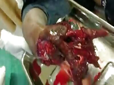 man with destroyed hands