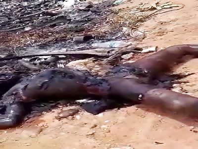 Burnt man smiling for the camera