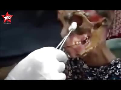 Krokodil (Russian Flesh Eating Opioid - compilation)