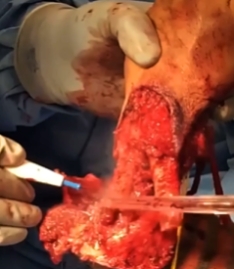 Hand cauterized during amputation